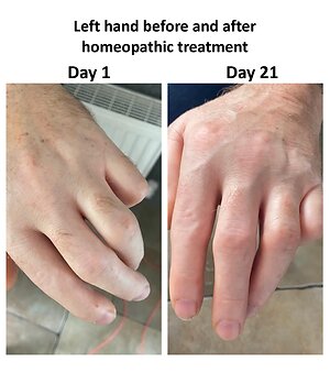 Homeopathy success stories. left hand updated