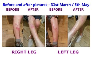 Homeopathy success stories. ECZEMA WHITE
